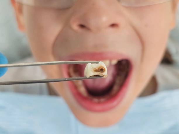 Best Emergency Dentist for Lost Fillings or Crowns in Santa Teresa, NM